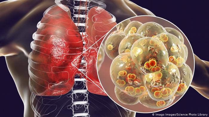 علائم درگیر شدن ریه&zwnj;ها با کرونا چیست؟