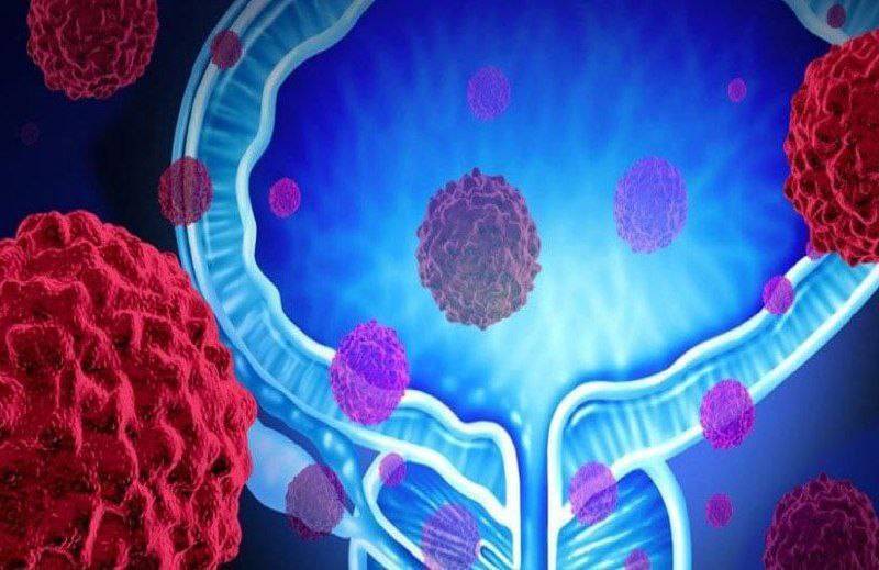 یکی از سرطان ها‌ی شایع در مردان سرطان پروستات است