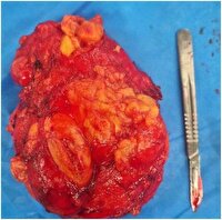 عمل جراحی موفقیت‌آمیز خارج کردن تومور ۱۵ سانتیمتری بازو در کاشمر